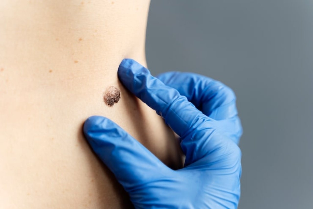 warts removal
