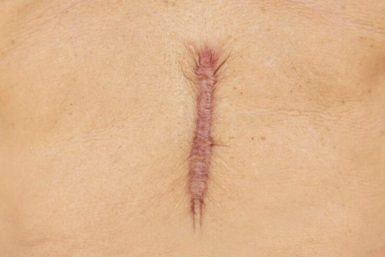 scar