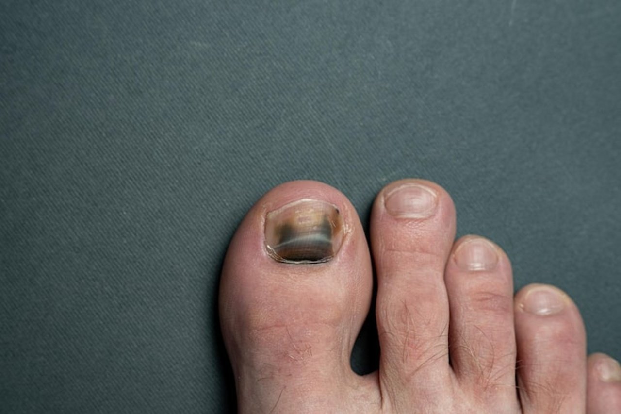 nail disorders
