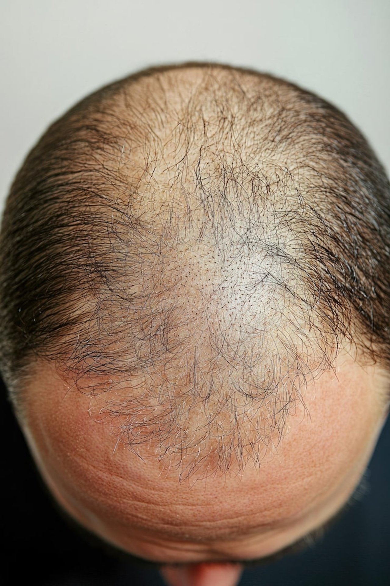 baldness
