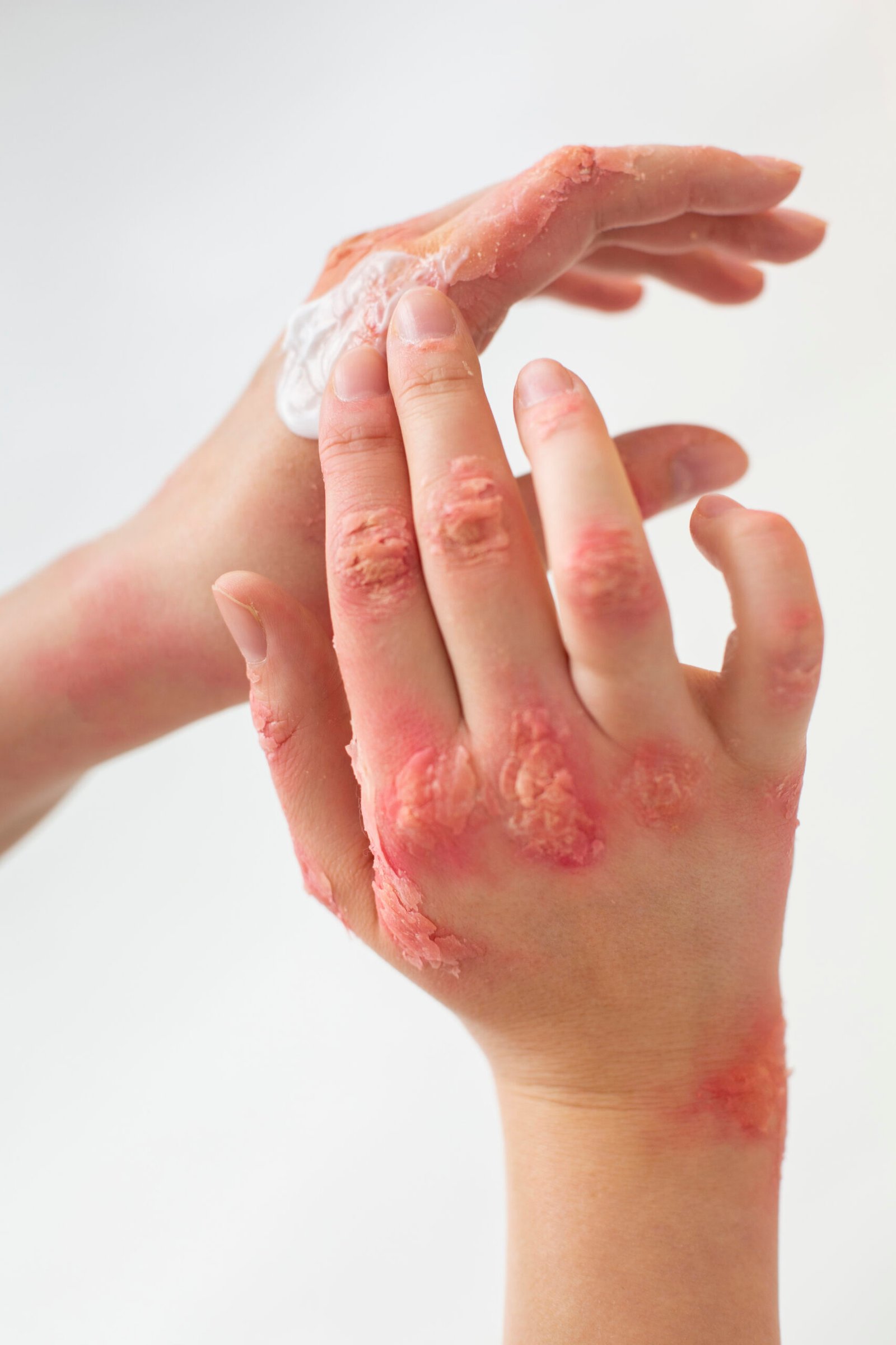 eczema2