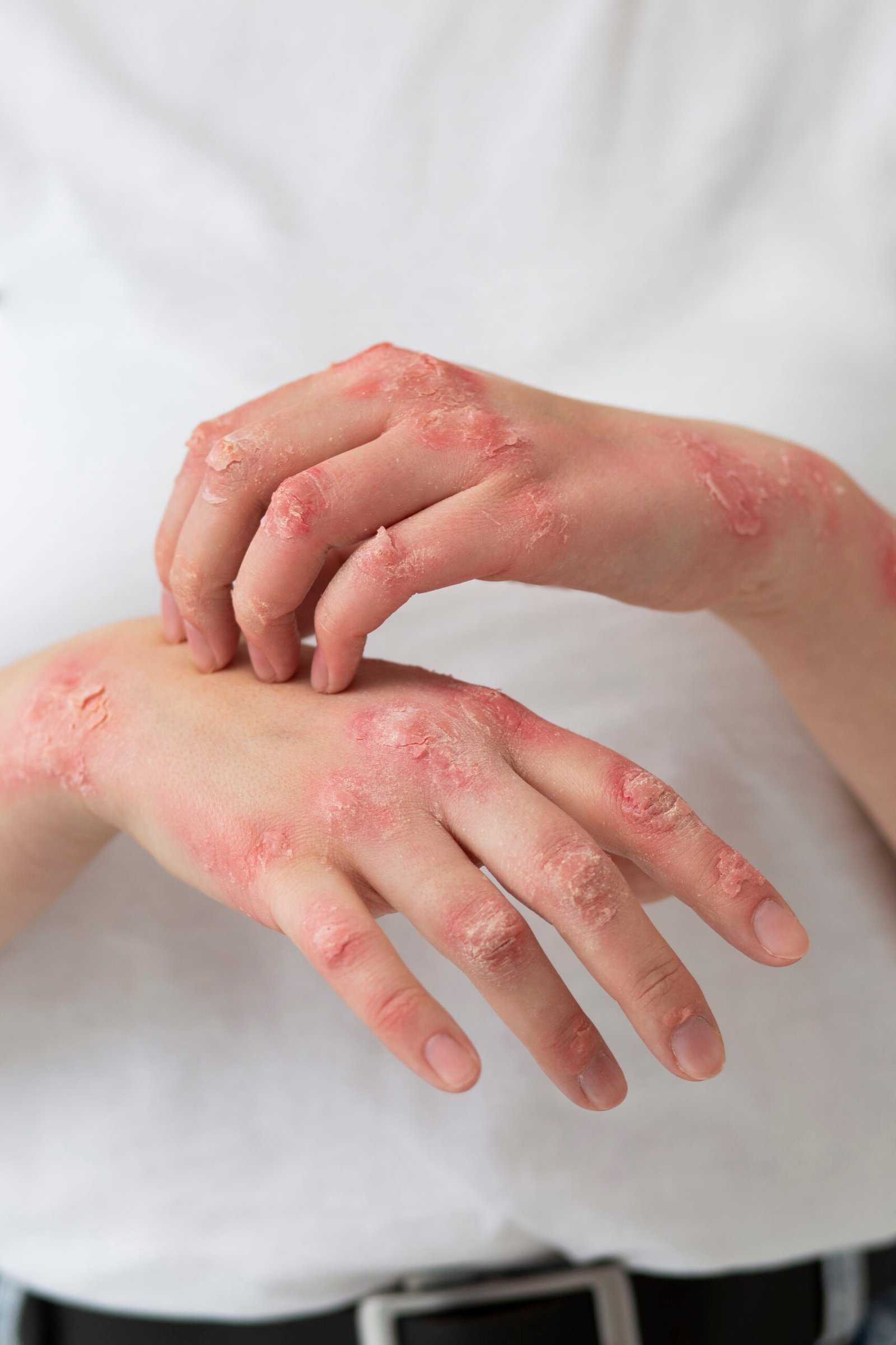 psoriasiss