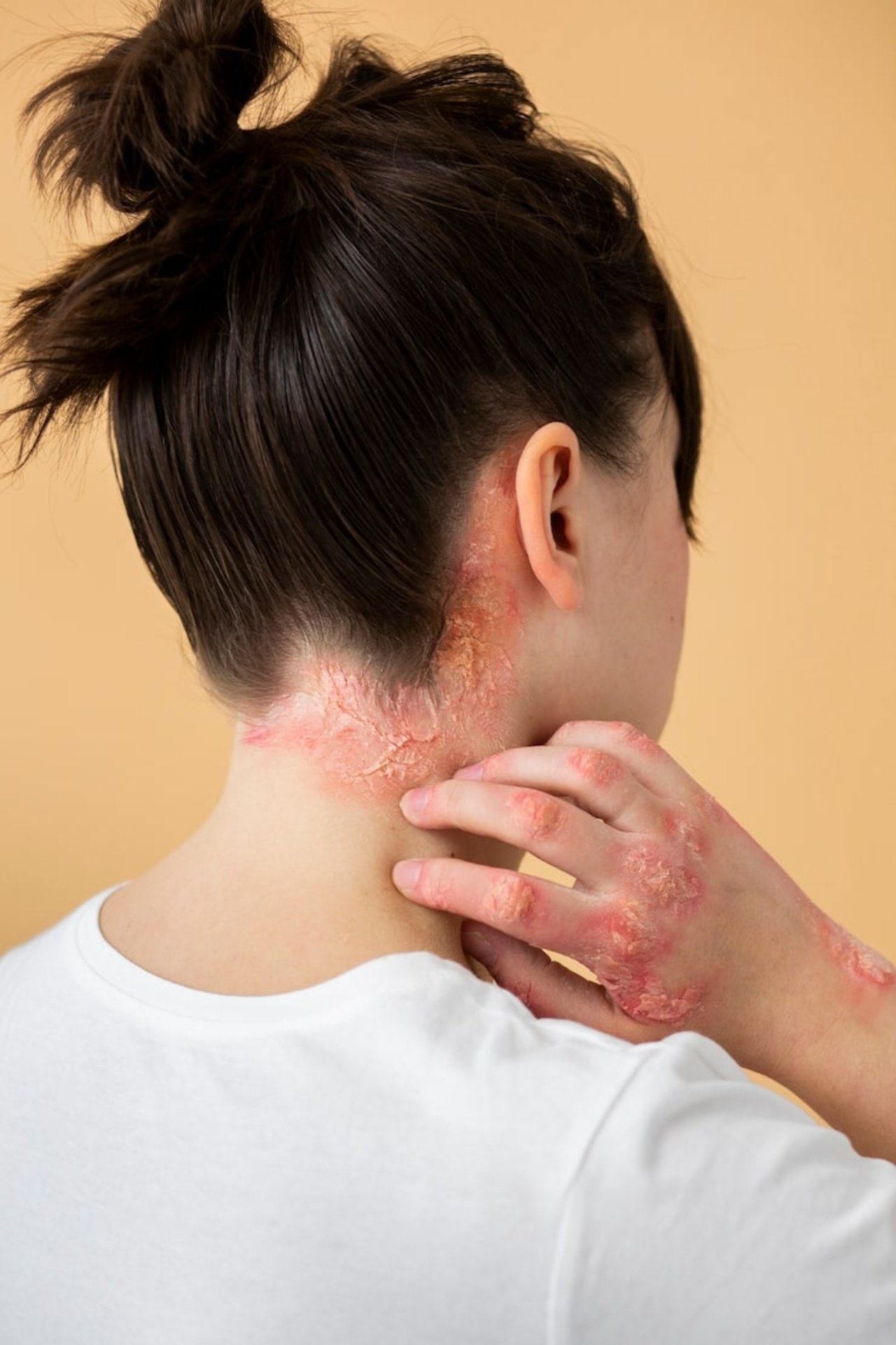 eczema