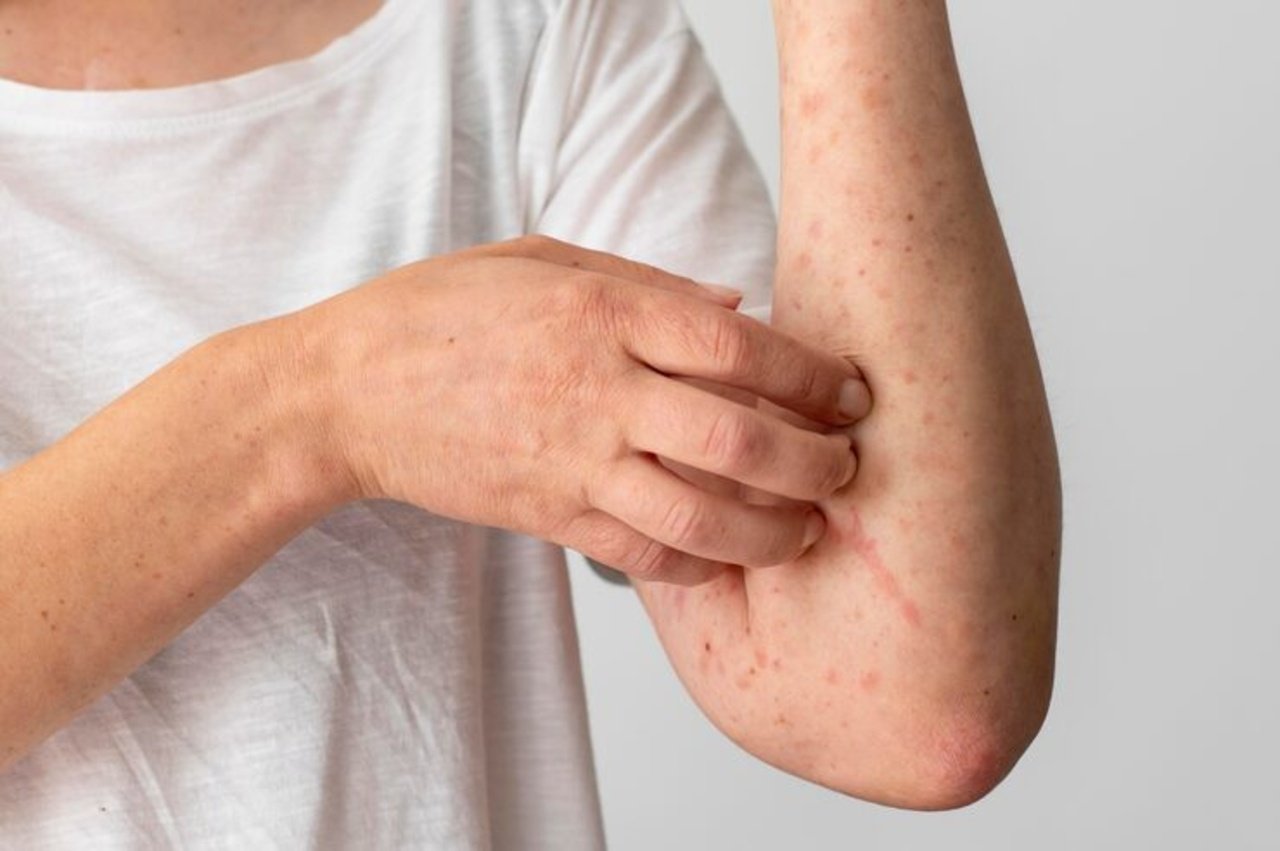 skin-allergy