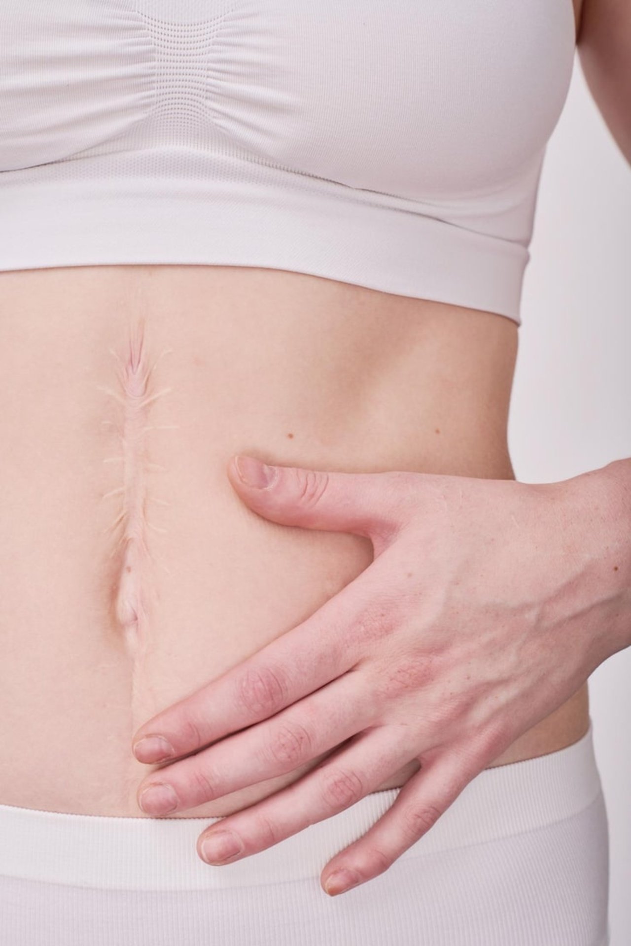 -scar-her-belly