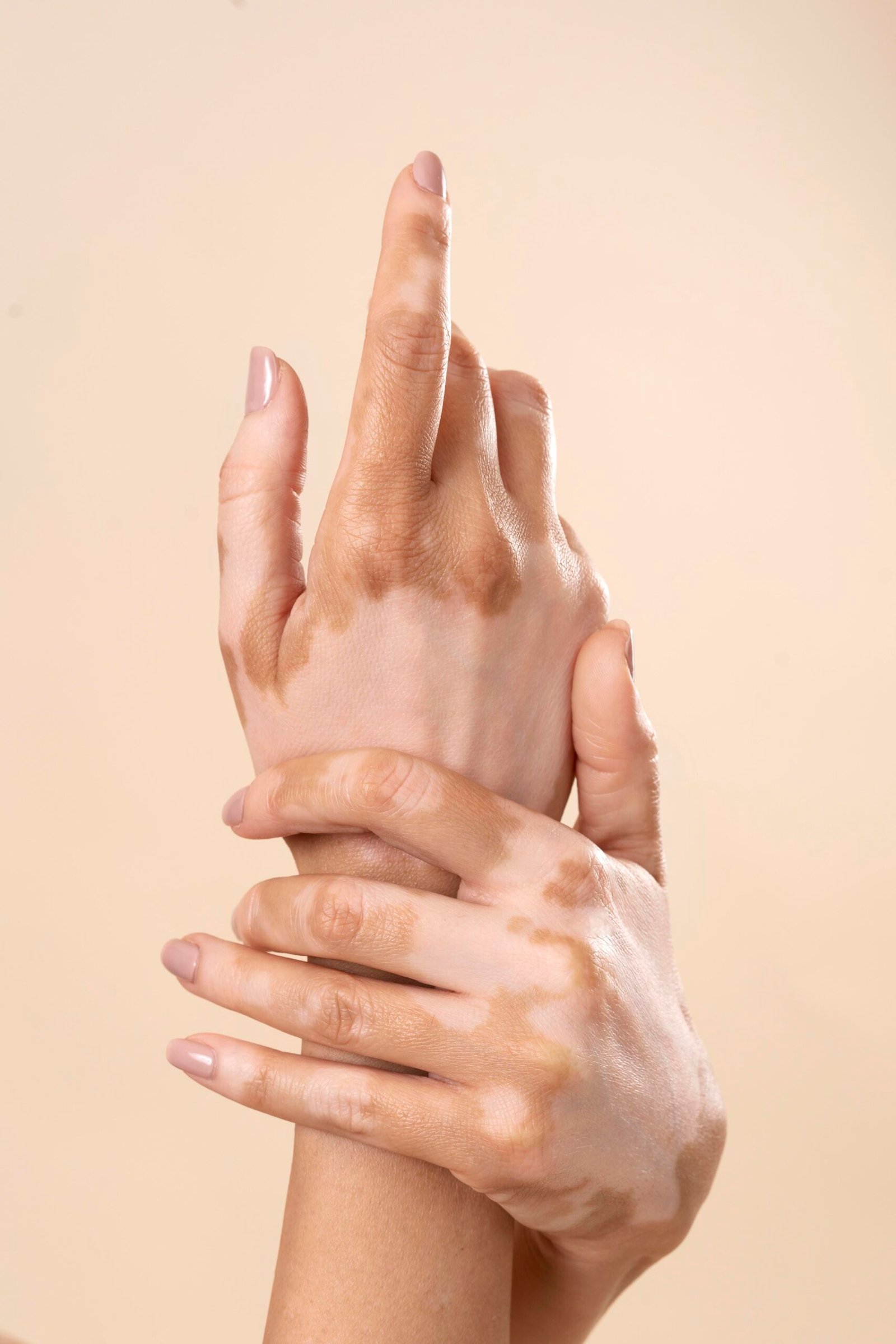 vitiligo2